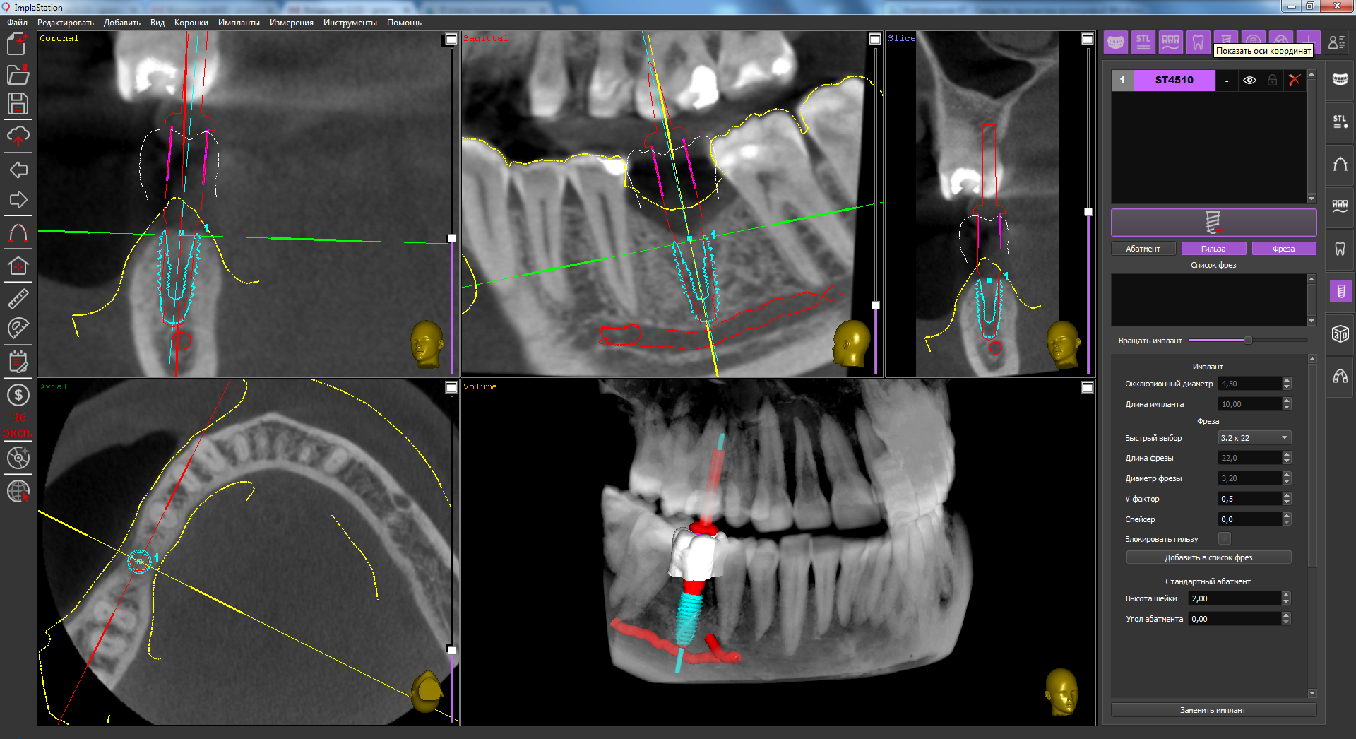 10_mm_implant_installation_by_using_a_surgical_guide