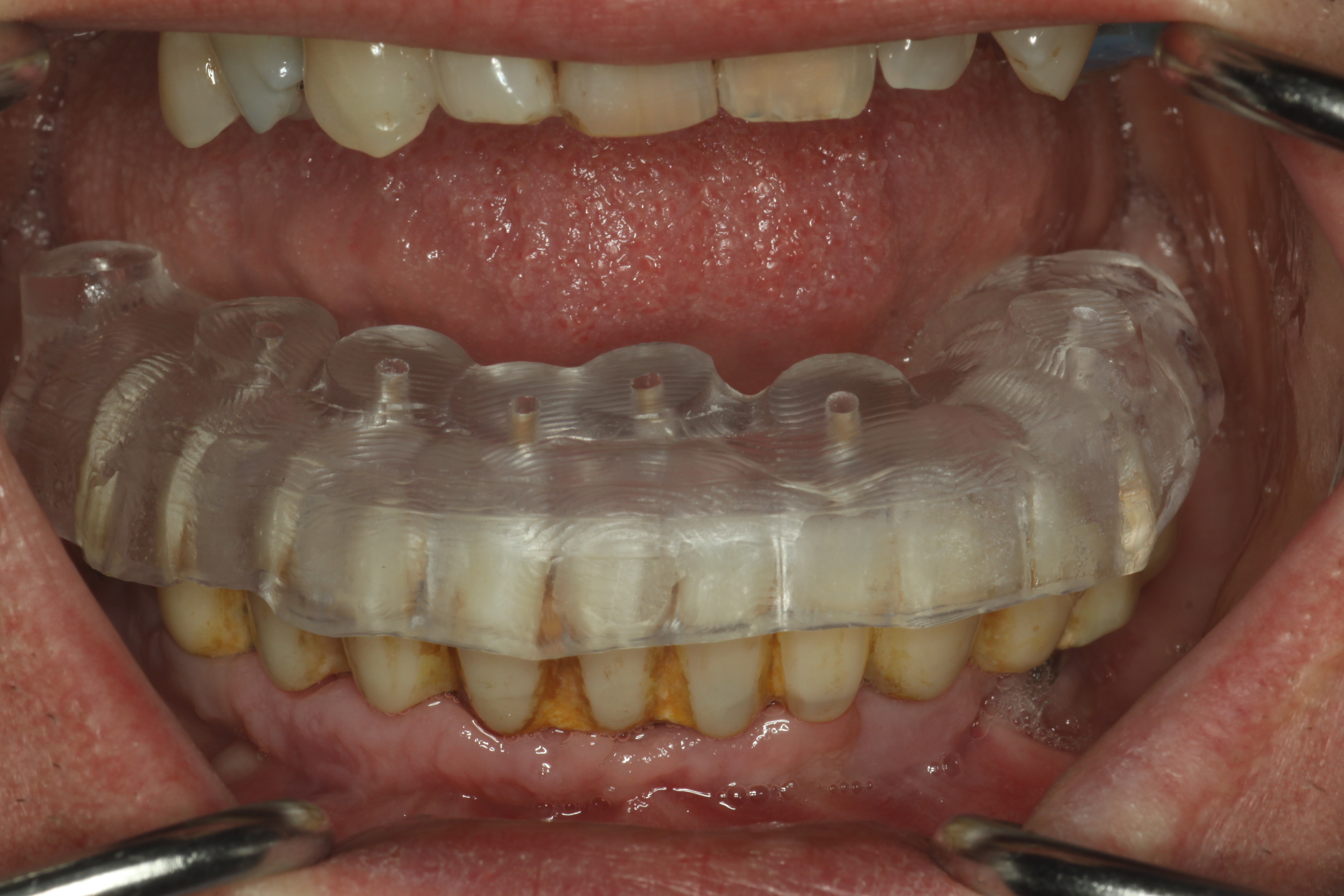 non-standard_use_of_the_guide_to_remove_the_bridge_prosthesis