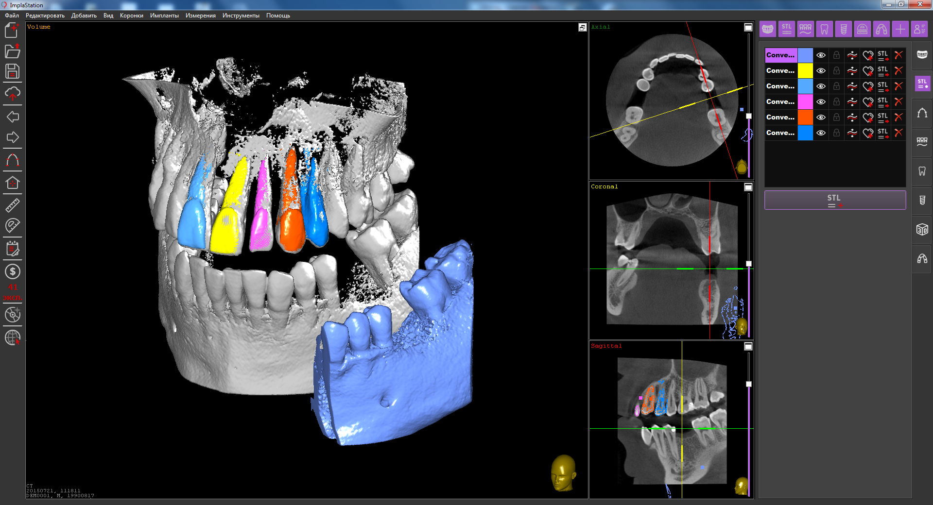 conversion_dicom-file_into_stl-surface