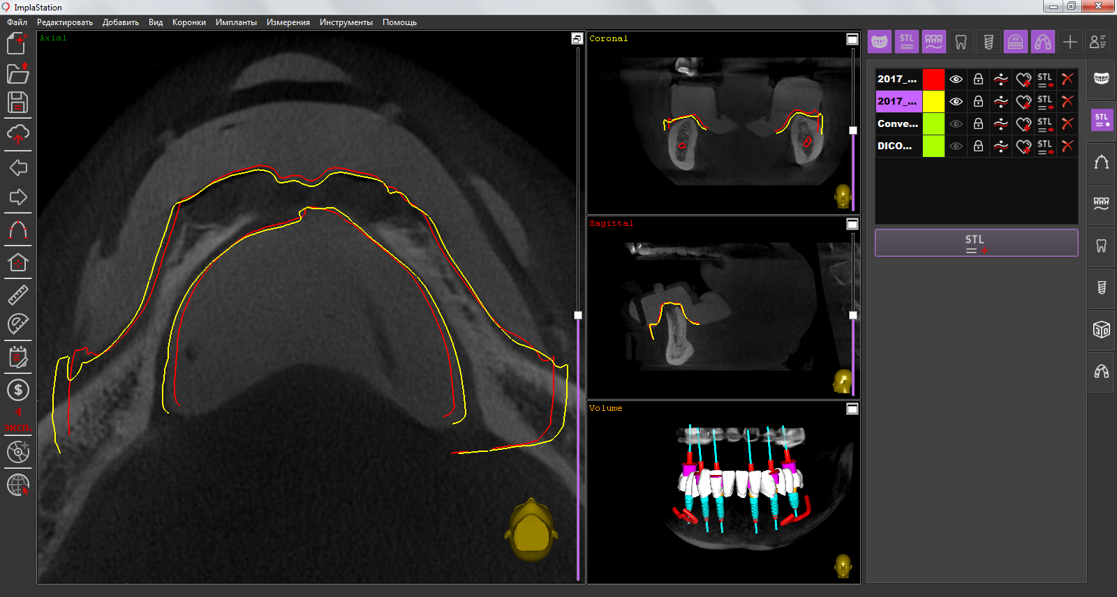 differences_in_the_st_and_optical_scan_data