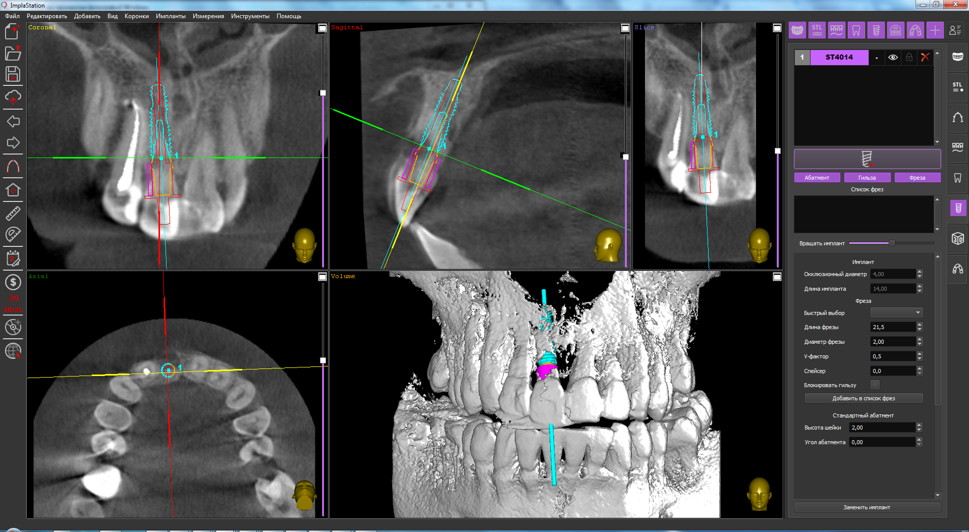 implant_installation_in_a_limited_space_by_using_a_surgical_guide