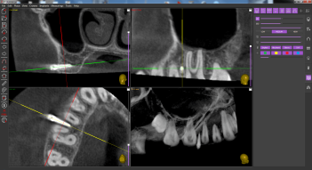 surgical_guide_in_orthodontics_precise_implant_placement_in_an_extremely_limited_space