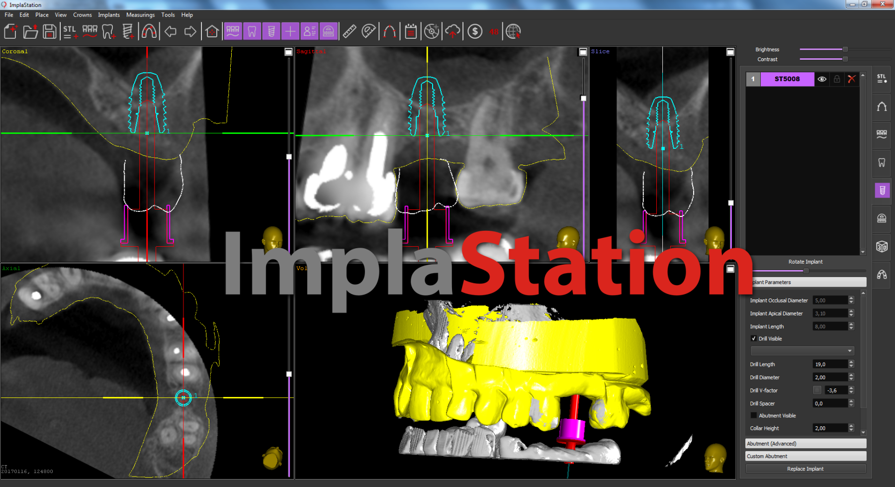 implantation_planning_using_the_technique_of_closed_sinus_lifting_and_ct_of_early_installed_implants