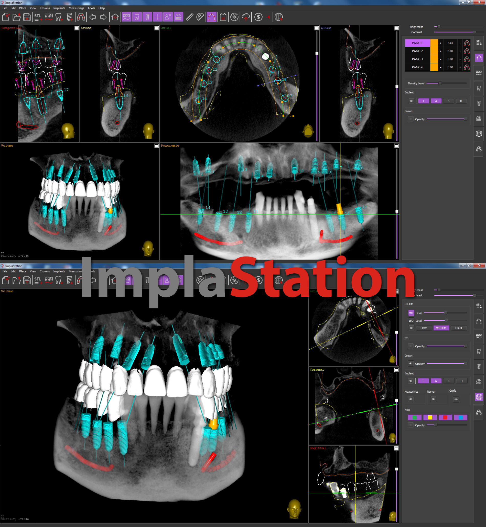 implantation_planning_with_a_fully_edentulous_of_an_upper_jaw_and_partial_of_a_lower_jaw_16_implants
