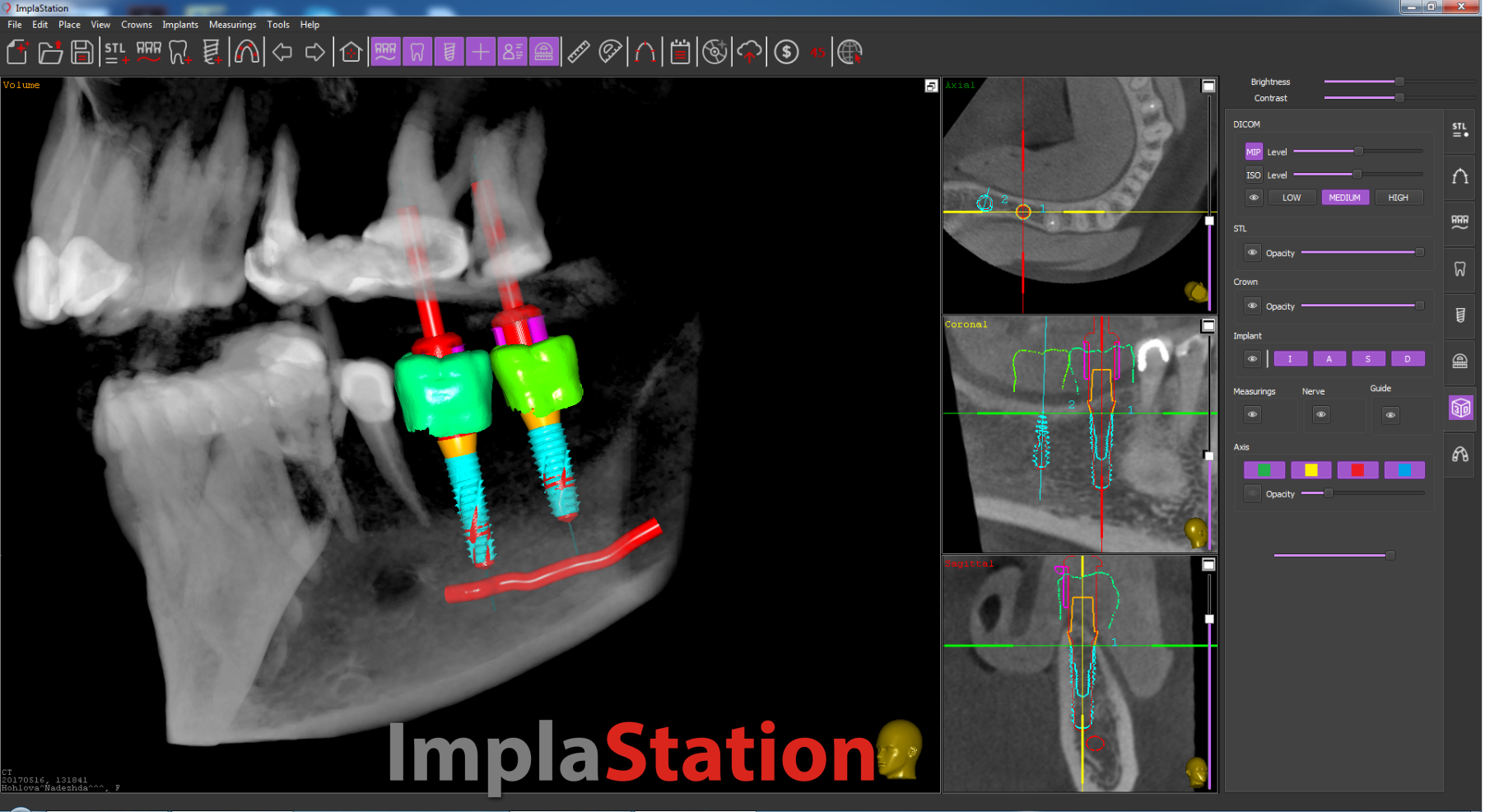 a_narrow_alveolar_crest_case