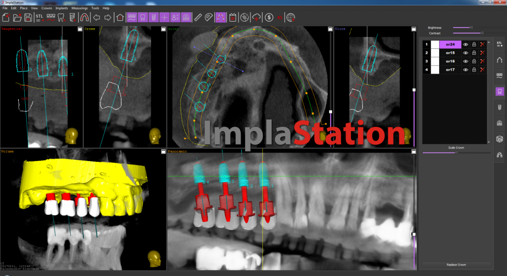 implantation_after_an_open_sine_lifting_operation