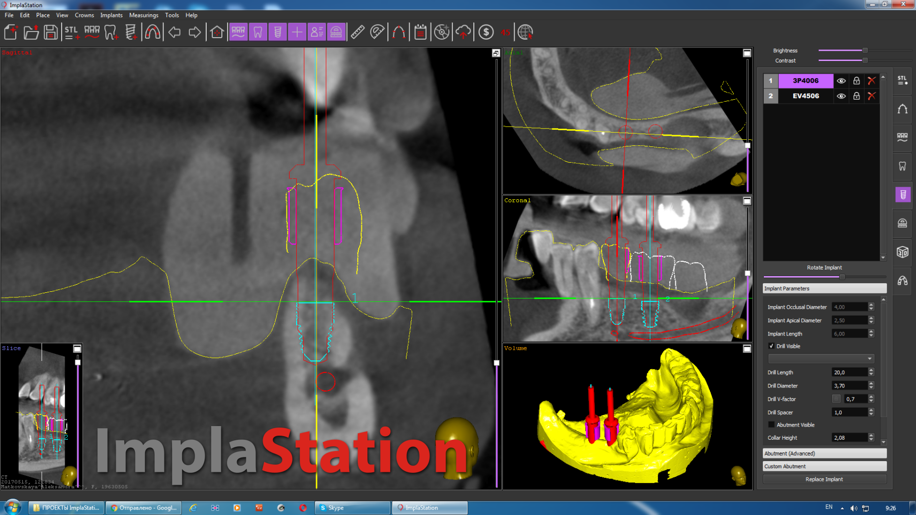 the_implantation_planning_in_the_case_of_a_distal_defect_in_the_fourth_quadrant