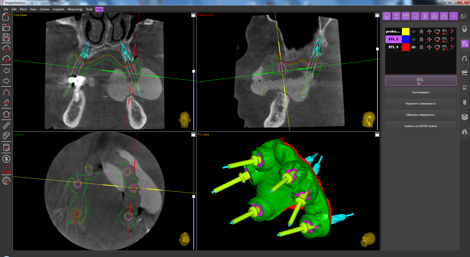 universal_double_scanning_technique_in_case_of_full_edentulous_jaw