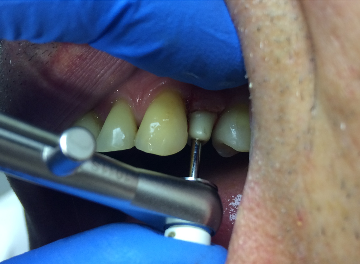 immediate_loading_with_pre-prepared_individual_abutment_and_crown