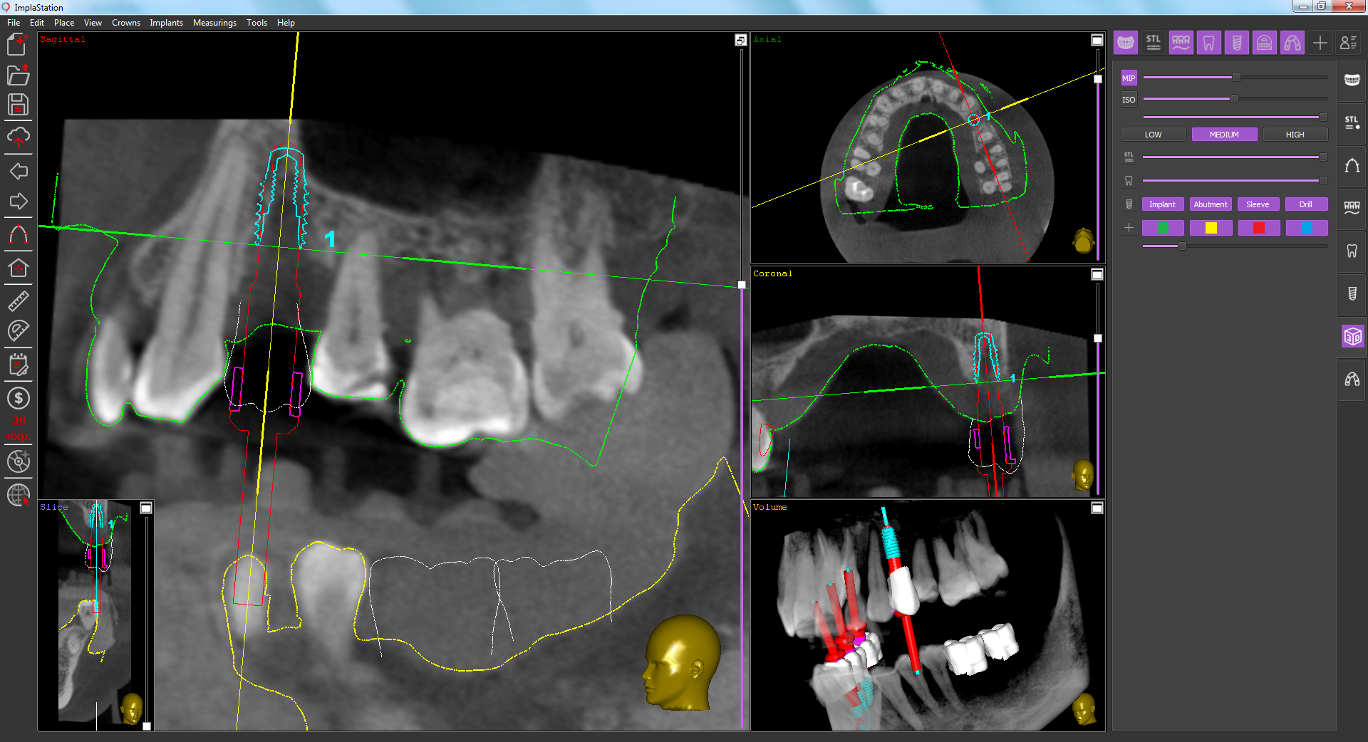implant_installation_in_immediate_proximity_of_the_sinus_bottom