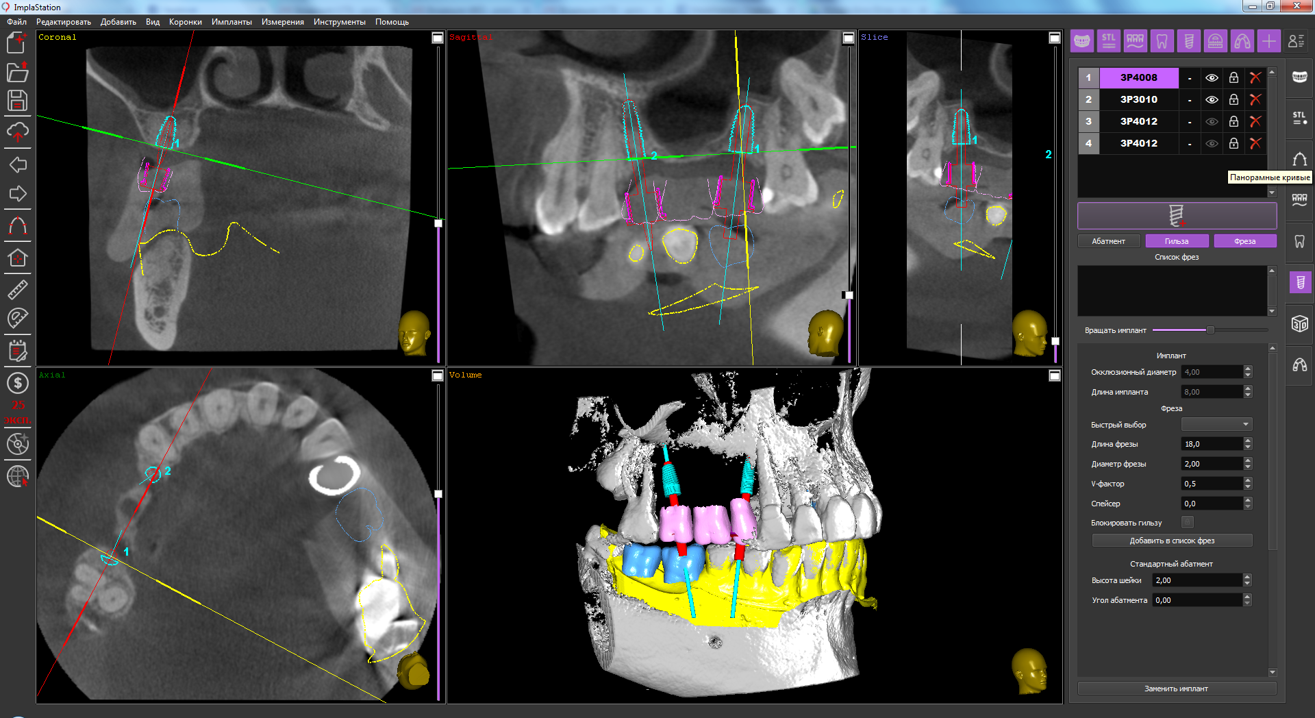 implant_installation_in_case_of_a_limited_bone_proposal_and_specific_form_of_the_sinus