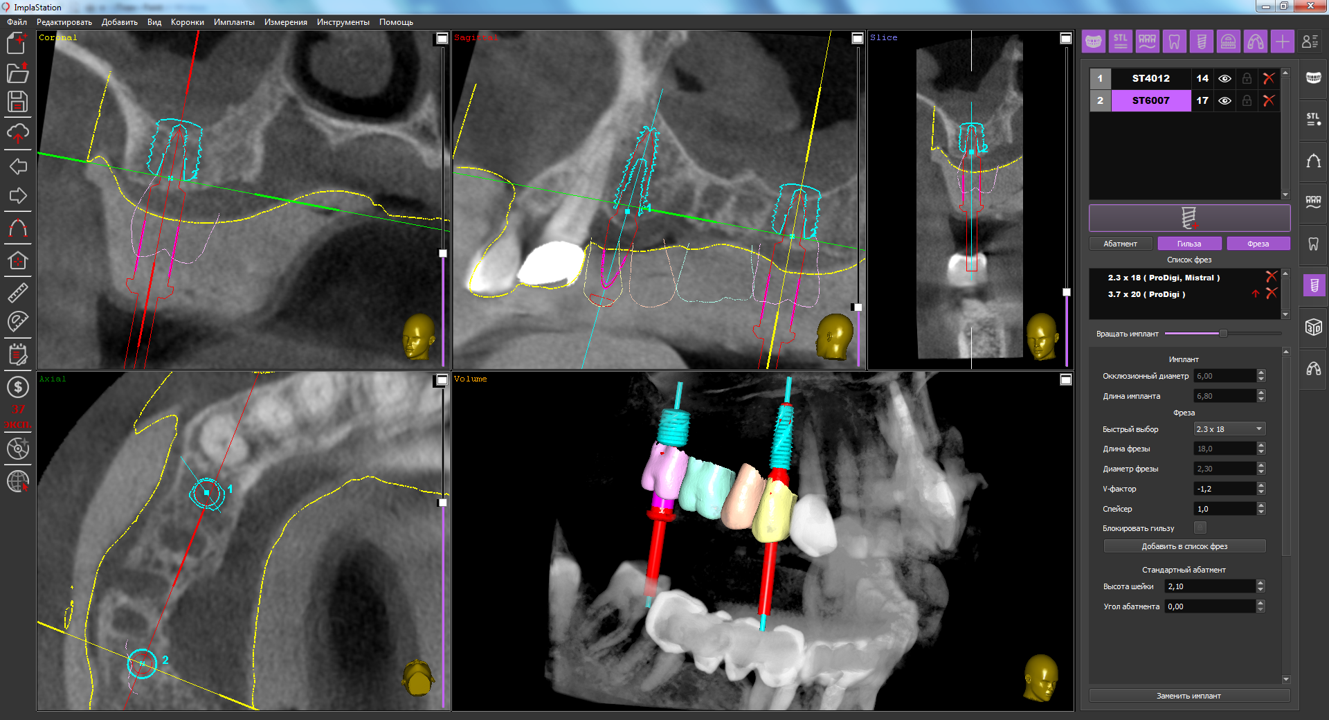 immediate_implantation_in_a_limited_bone_supply