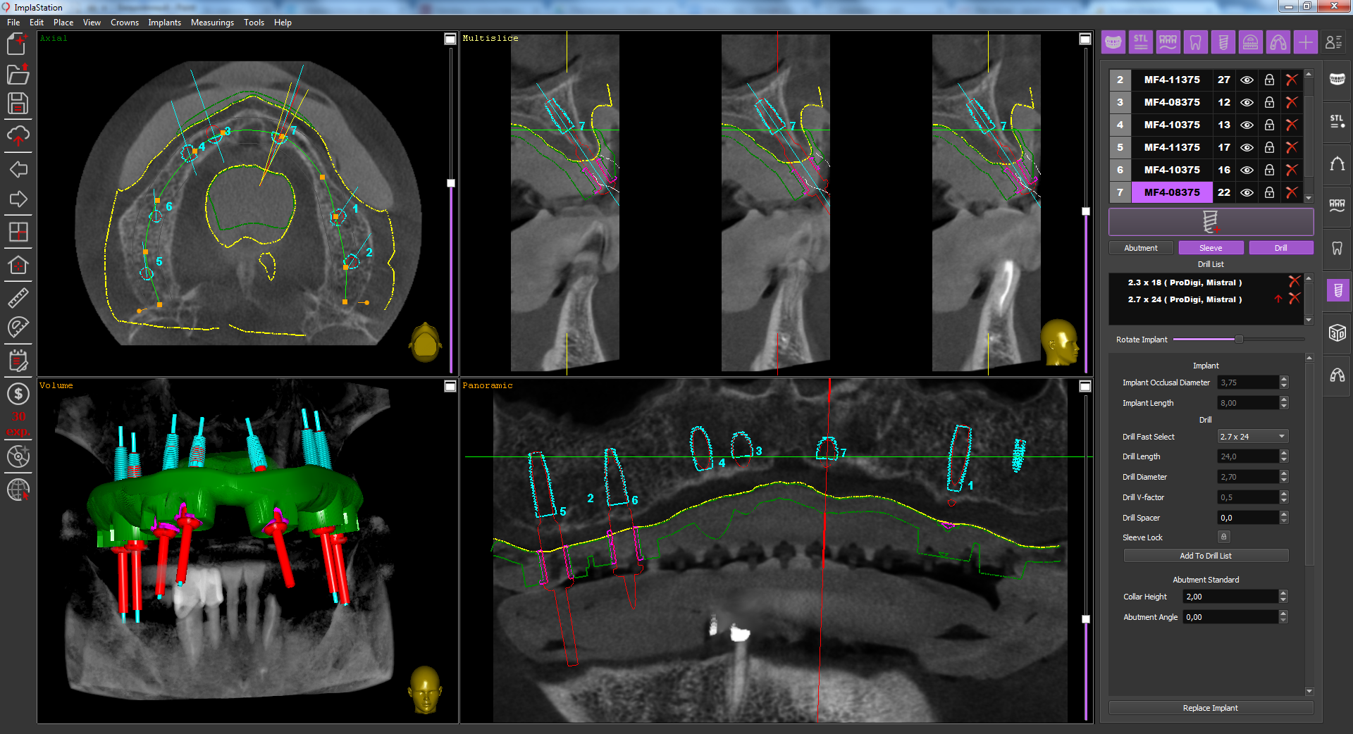 how_to_identify_the_mucosa_contour_in_case_of_full_adentia