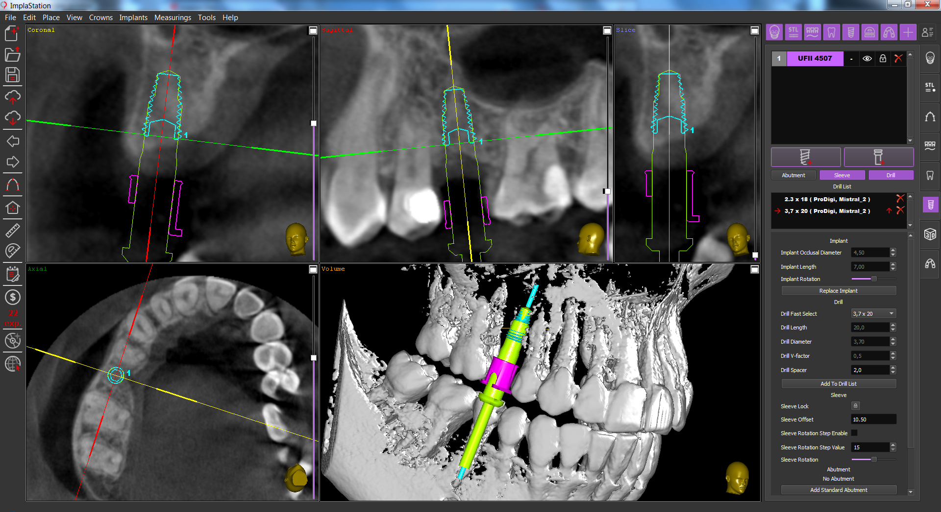 implant_installation_on_the_maxilla_case_when_the_bone_proposal_is_limited