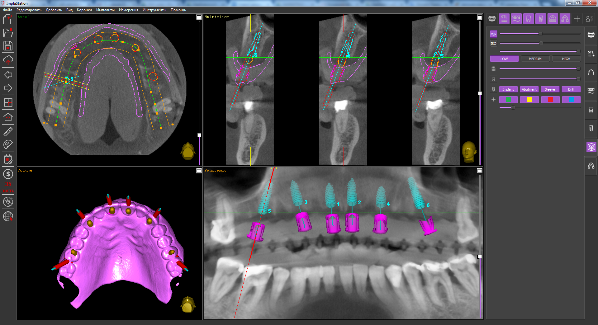 implant_placing_for_the_subsequent_installation_of_the_prosthetic_bridge_on_multiunits