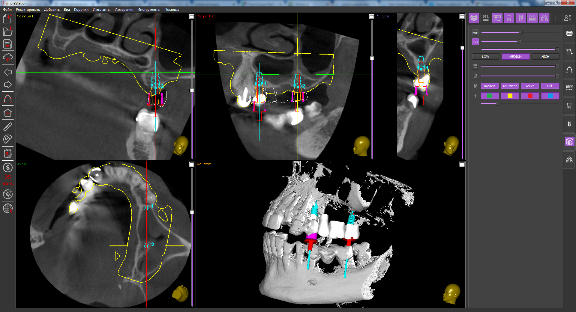 implant_installation_on_the_maxilla_in_conditions_of_limited_bone_proposal