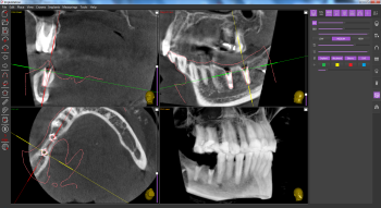 checking_the_accuracy_of_actual_and_planned_implant_treatment_in_implastation
